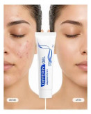 ژل ضد جوش دیفرین آداپالن اصل فرانسه